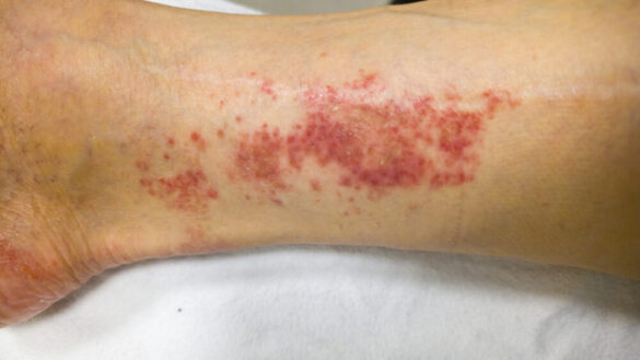 Granulomatös polyangit (GPA) – orsak, symtom & behandling