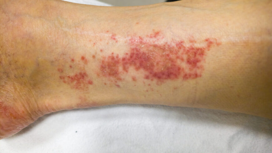 Granulomatös polyangit (GPA) – orsak, symtom & behandling