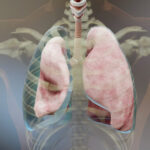 Pneumothorax – orsak, symtom & behandling
