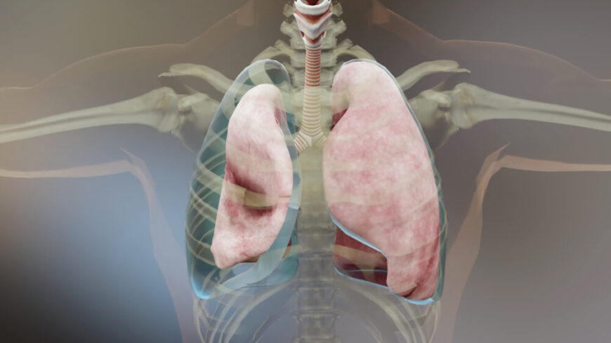 Illustrationen visar en pneumothorax (lungkollaps), där luft i lungsäcken gör att lungan helt eller delvis faller ihop. Tillståndet kan orsaka plötslig bröstsmärta och andfåddhet och behöver ibland behandlas akut. Foto: Getty Images