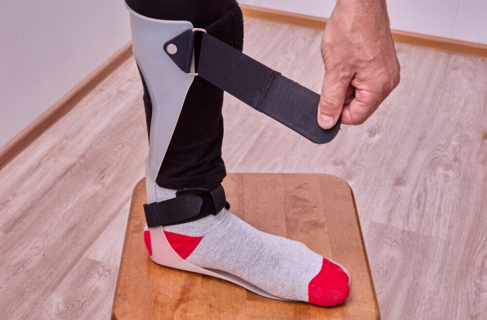 Droppfot – orsak, symtom & behandling