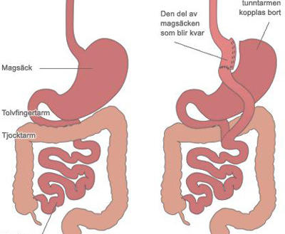 Anni ville inte bli sjuk – genomgick Gastric Bypass