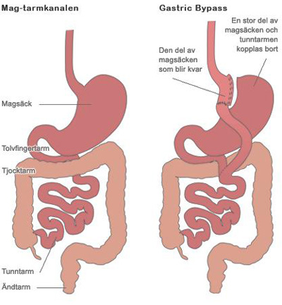 Anni ville inte bli sjuk – genomgick Gastric Bypass