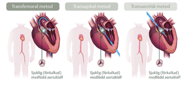 tavi operation hjärta tavi operation hjärta