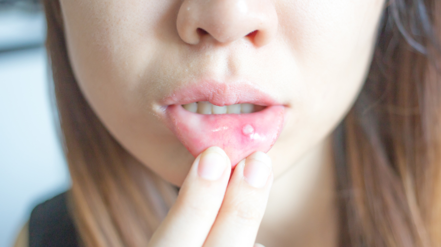 Afte är blåsor och sår i munslemhinnan. Foto: Shutterstock