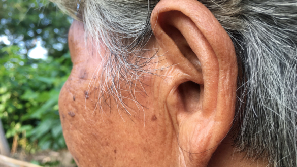 Ansiktsförlamning: symtom, orsak & behandling