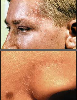 Seborroiskt eksem (mjälleksem)