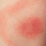 Borrelia – symtom och förebyggande åtgärder