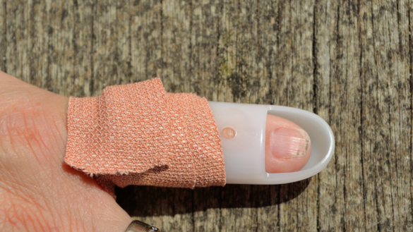 Droppfinger (Malletfinger): orsaker och behandling