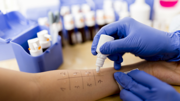 Födoämnesallergi (matallergi): orsak, symtom & behandling