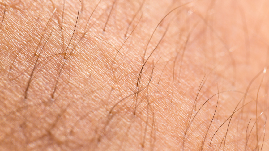 Vid hirsutism kan håret på olika platser bli grövre, mörkare och mer synligt. Foto: Shutterstock