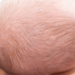 Mjölkskorv hos barn: symtom, förlopp & behandling