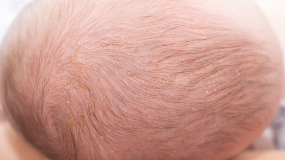 Mjölkskorv hos barn: symtom, förlopp & behandling