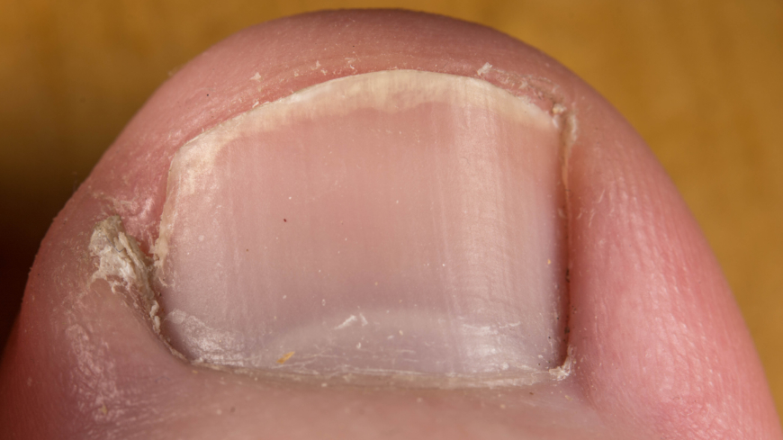 Vid nageltrång skär nageln in i intilliggande hud och det blir svullet och smärtar. Foto: Shutterstock
