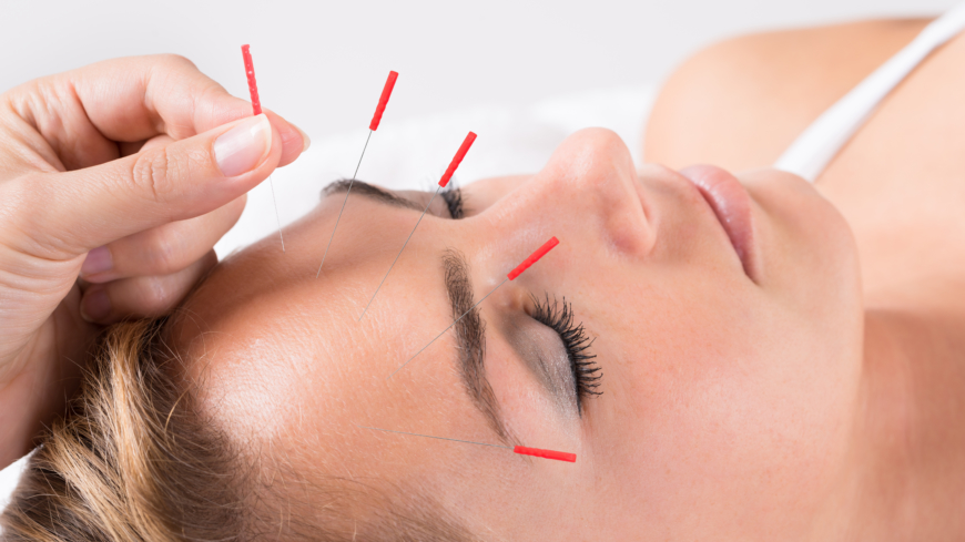 Akupunktur kan hjälpa mot vanlig kvinnosjukdom