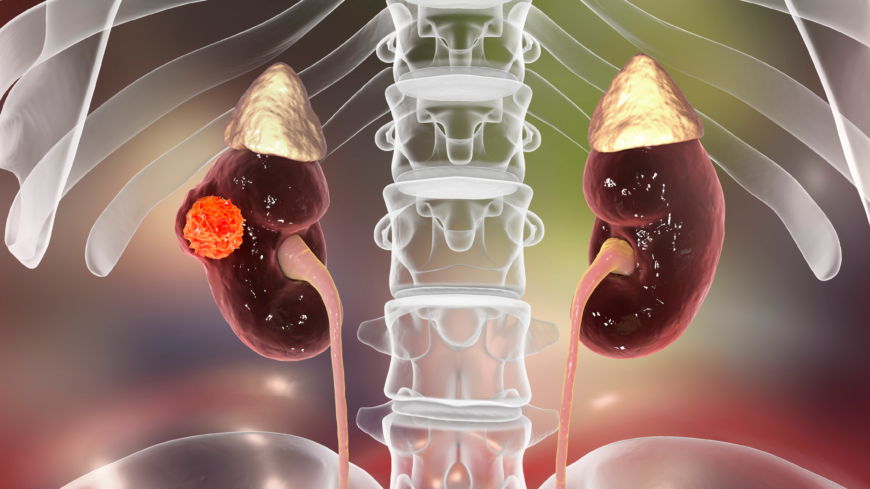 Att identifiera njurcancer med ökad risk för spridning är av vikt för att förbättra patientens prognos. Foto: Shutterstock