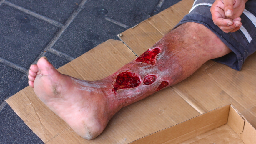 Fot- och bensår kallas svårläkta sår på ben eller fötter som lätt blir infekterade. Foto: Shutterstock