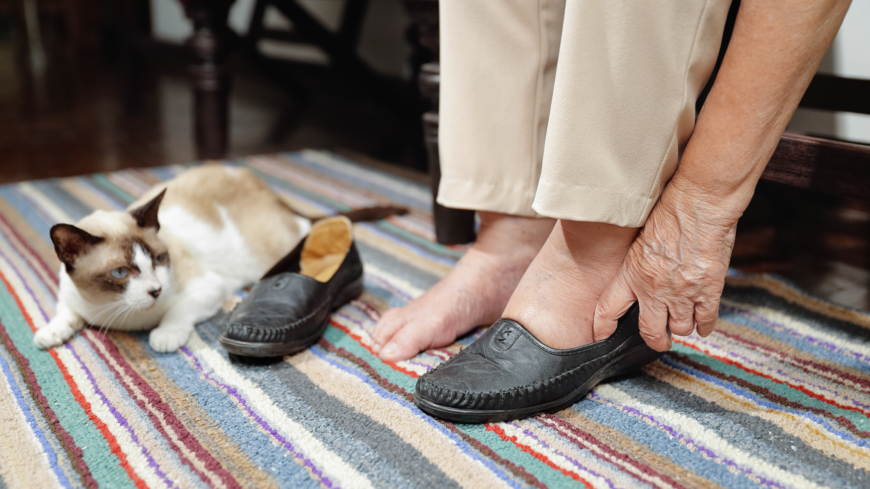 Ödem är resultatet av att vätska av någon orsak samlas i ben och i fötter.  Foto: Shutterstock