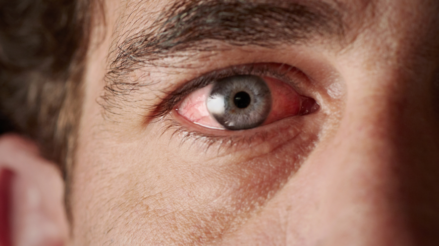 Ofta är ögat rött och fuktigt efter en operation och brukar vara det i en till två veckor. Foto: Shutterstock