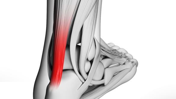 Hälsenebristning (hälseneruptur)