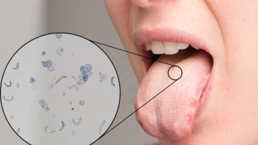 cancer på tungan symtom