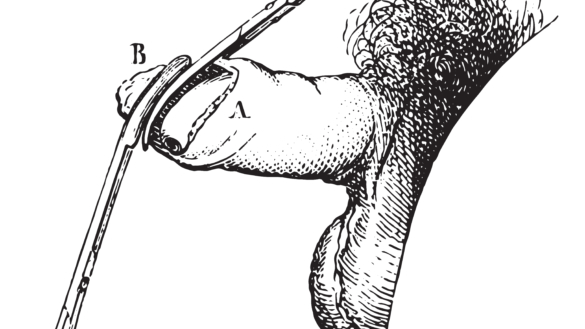 Förträngning av förhuden (fimosis)
