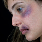 Slag mot ögat: symtom, orsak & behandling