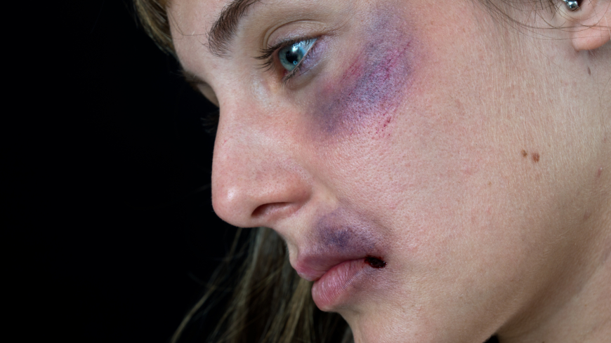 Om man får ett slag mot ögat man kan få en blåtira som orsakas av en blödning under huden. Foto: Shutterstock