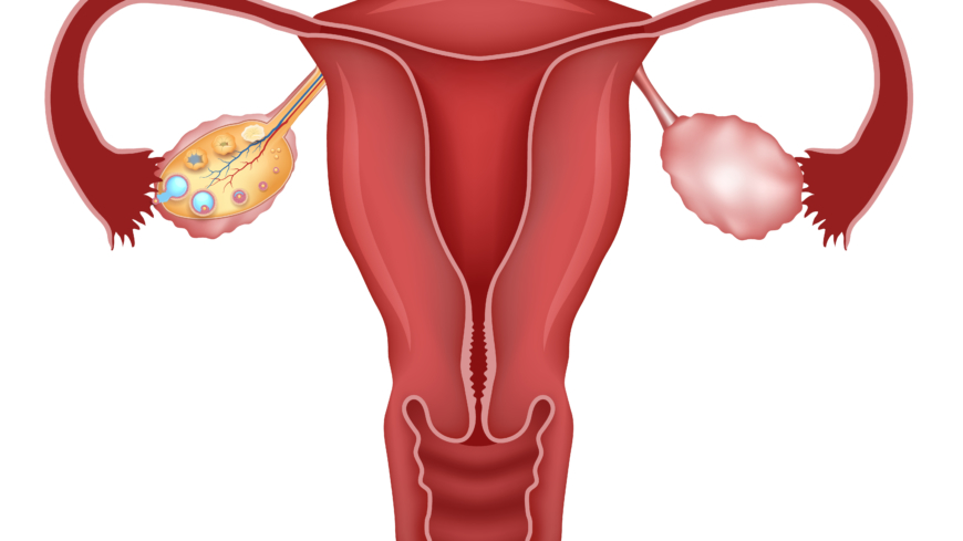 Vid Polycystiskt Ovarialsyndrom får man vätskefyllda blåsor i äggstockarna som bland annat kan orsaka infertilitet. Foto: Shutterstock
