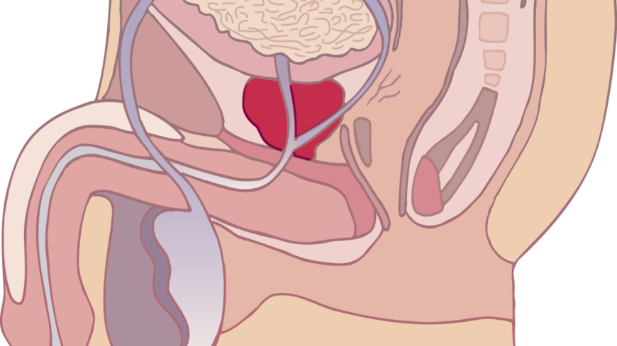 Prostatit kallas de olika besvär som män kan få med prostatakörteln. Foto: Shutterstock