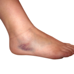 Stukningar och blåmärken (hematom)