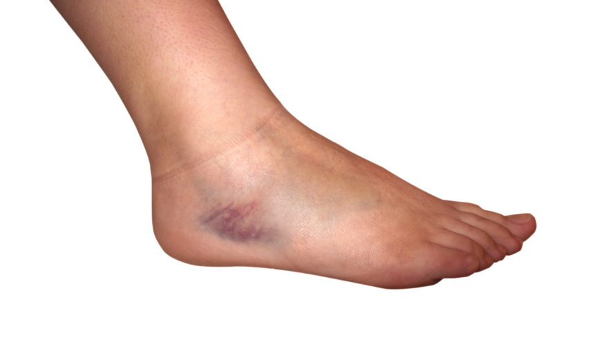 En stukad fot innebär att vävnaderna i fotleden skadats. Foto: Shutterstock
