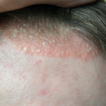 Webb-TV: Psoriasis del 3