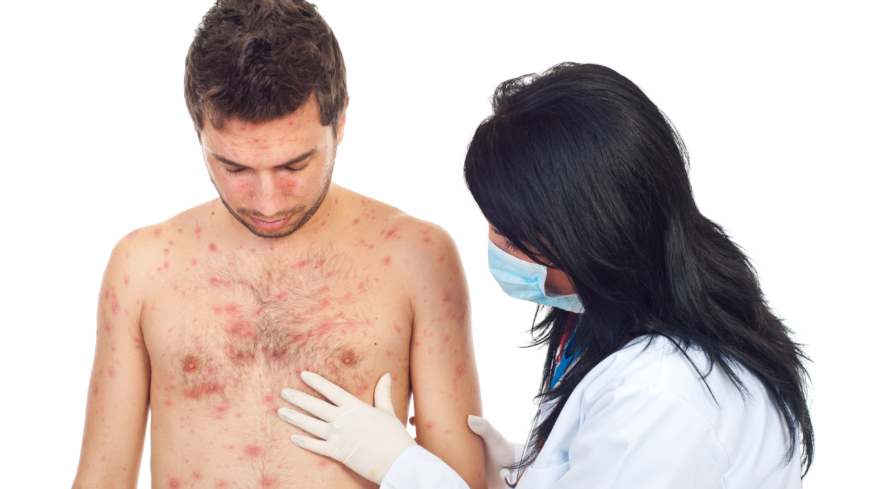 Fjällros är en hudsjukdom som ger irriterade utslag över hela kroppen. Foto: Shutterstock