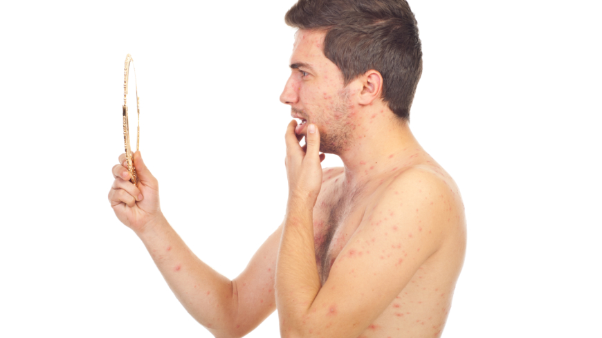 Rosfeber är en akut hudinfektion som visar sig som rodnader på kroppen. Foto: Shutterstock