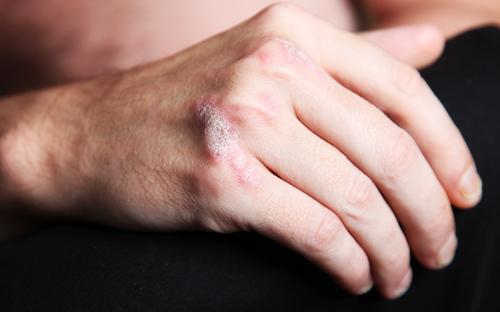 Hämmandet av protein kan visa sig effektivt vid behandling av psoriasis