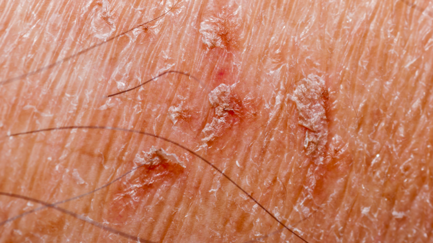 Webb-TV: Psoriasis del 2