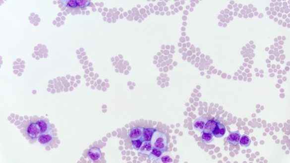 Nära släkt löper inte ökad risk att drabbas av akut leukemi