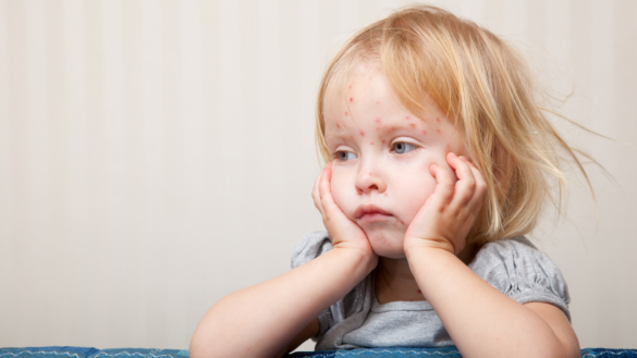 Vattkoppor (varicella): orsak, symtom & behandling