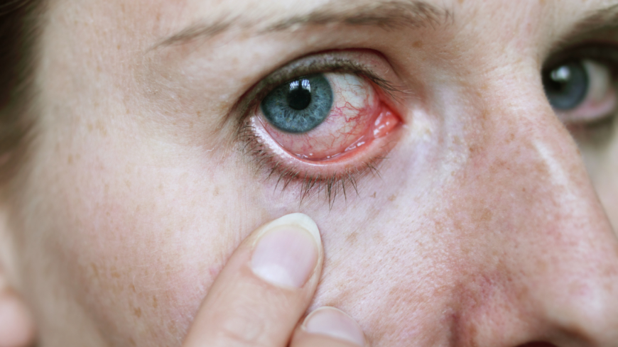B-vitamin och ljusbehandling vid ögoninfektion