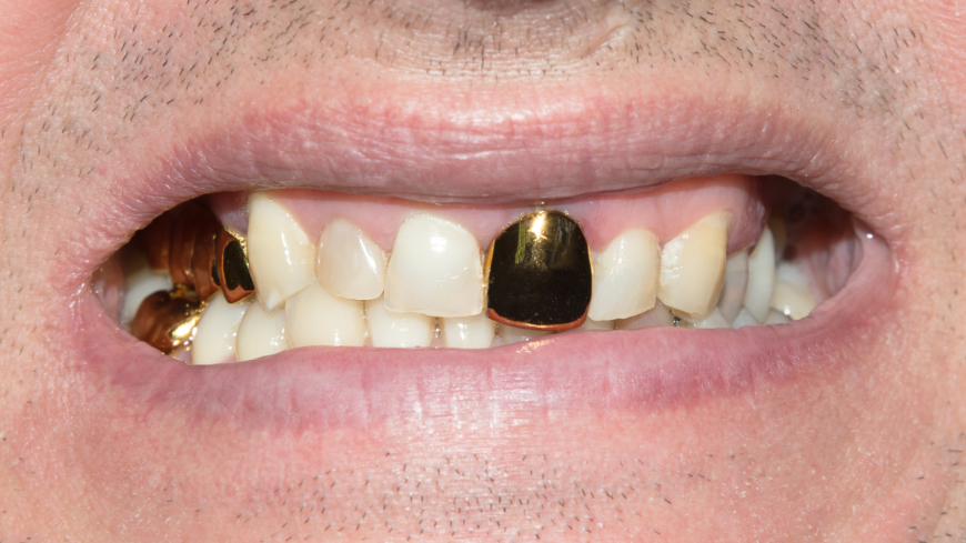 Guld i munnen ökar risken för kontaktallergi