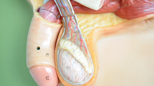 Klinefelters syndrom: medfödd kromosomrubbning hos män