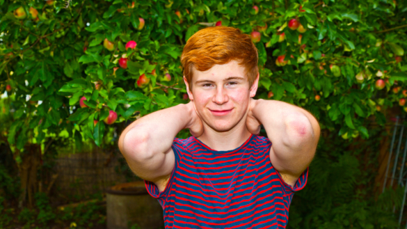 Akne (finnar) – se bilder och exempel