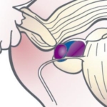 Blod i sädesvätskan (hematospermi)