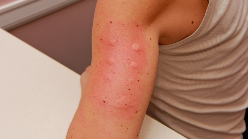Ett pricktest kan avslöja allergener som kan orsaka allergisk shock. Foto: Shutterstock
