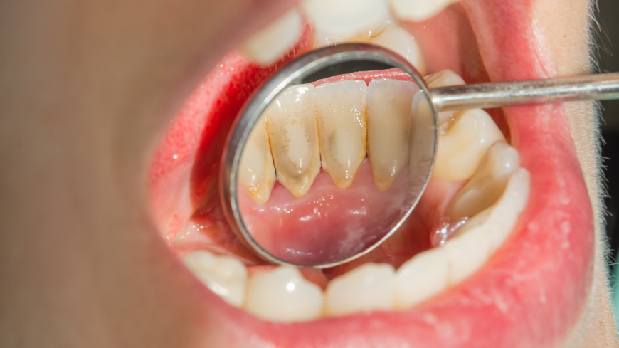 Det plack som uppstår på våra tänder vid bakterieangrepp blir till tandsten när det blandas med salter och mineraler från vår saliv. Foto: Shutterstock