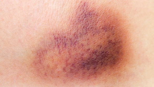 Trombocytopeni (brist på blodplättar)