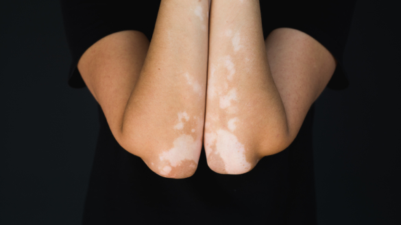 Vitiligo (vita hudfläckar): orsaker, symtom & behandling