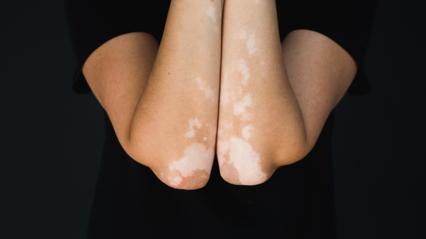 Storleken på de vita områdena vid vitiligo varierar, men de är oftast kraftigt avgränsade mot den friska huden. Foto: Shutterstock