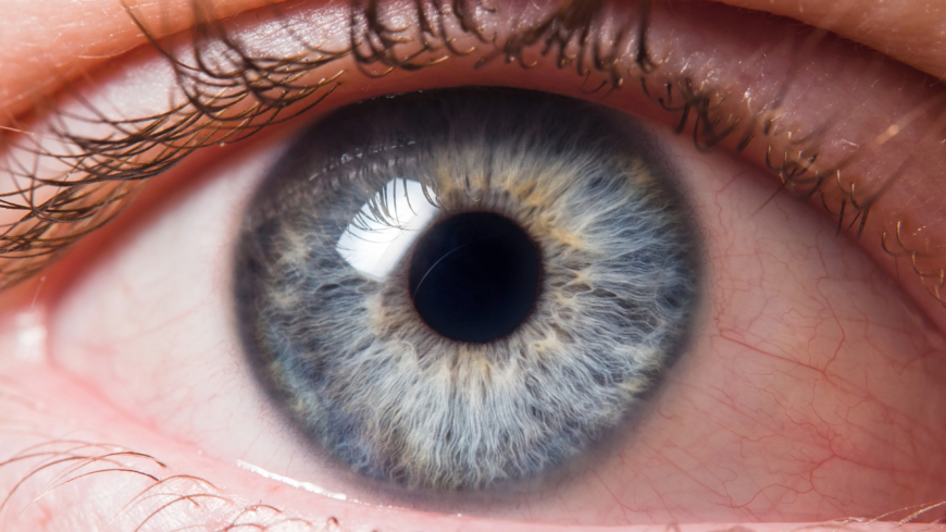 Ögonrosacea kan leda till en rad symtom i ögonen, som t ex röda, torra, irriterade eller grusiga ögon. Foto: Shutterstock